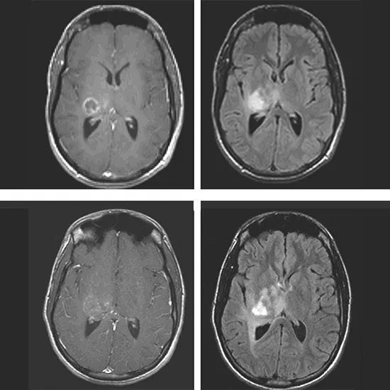 Brain Tumor : Types, Stages, Symptoms, Causes and Tests | Ganesh Diagnostic