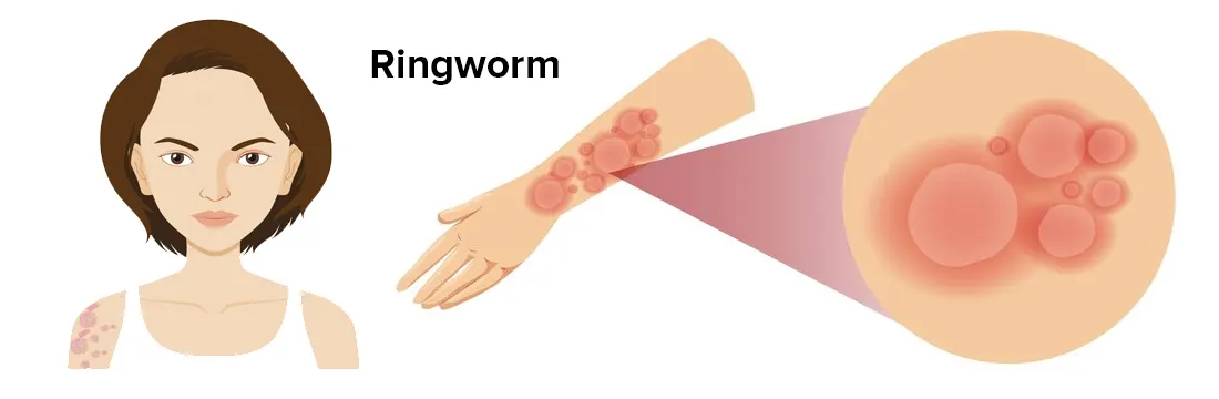 Ringworm