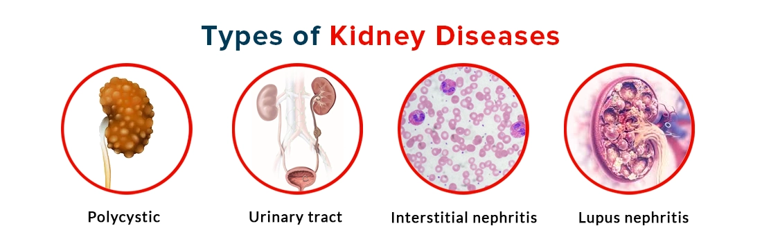 Chronic Kidney Diseases : Symptoms, Causes, Diagnosis and Treatment