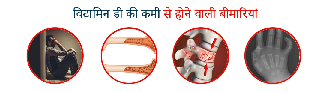 Vitamin D Deficiency Diseases in Hindi