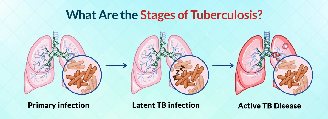 What Are the Stages of TB