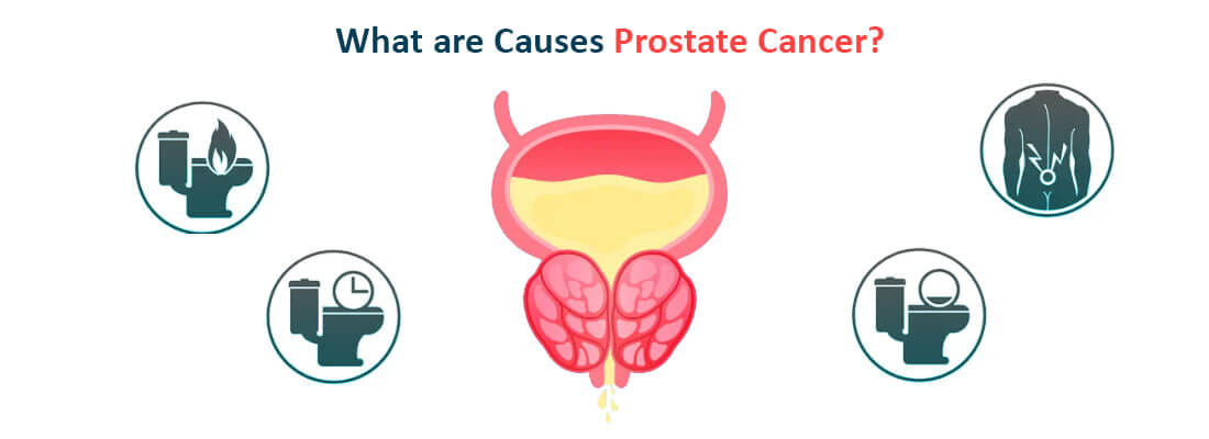 Detect Prostrate Cancer Early? Importance Of Screening And Blood Tests 