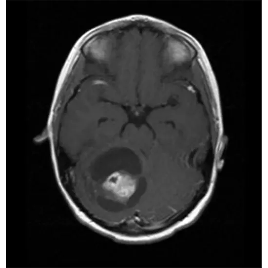 Cerebral Astrocytoma: Types, Causes, Symptoms & Treatment