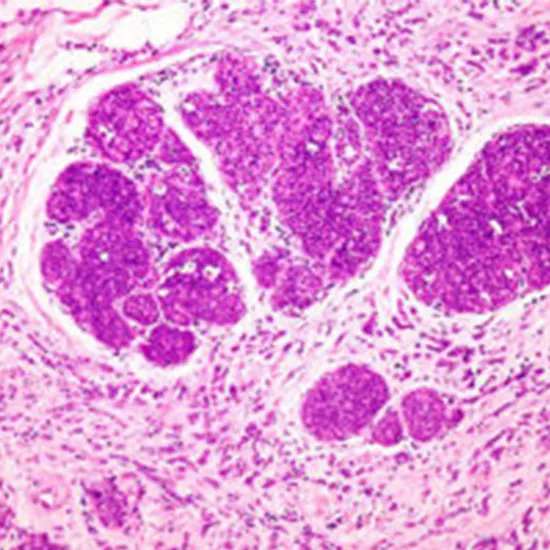 Invasive Lobular Carcinoma (ILC): Causes, Symptoms & Treatment