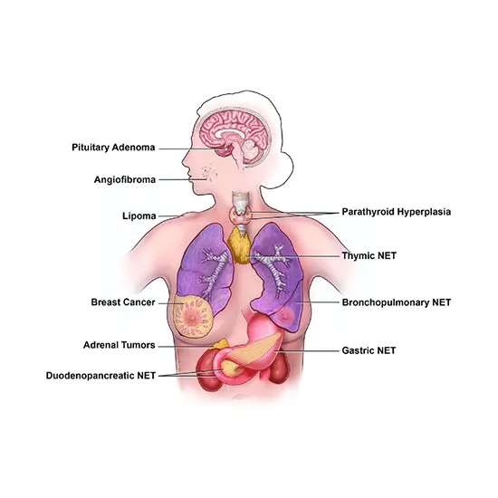 Understanding Multiple Endocrine Neoplasia A Rare Genetic Disorder with ...