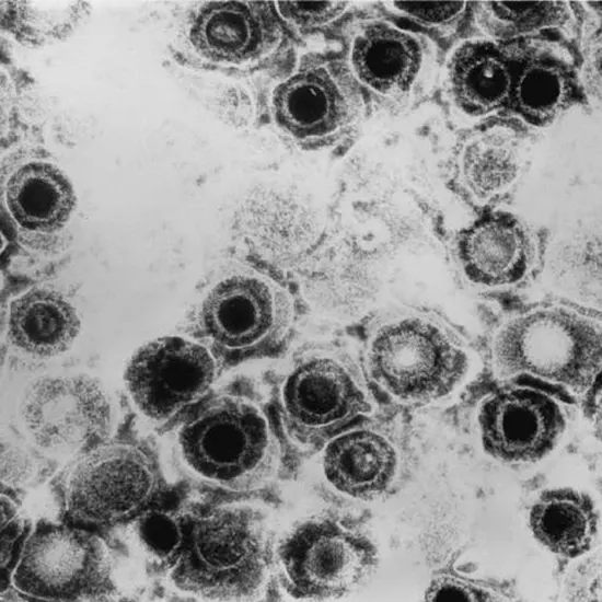 Human Herpesvirus 6 (HHV-6) and Human Herpesvirus 7 (HHV-7) | Ganesh ...