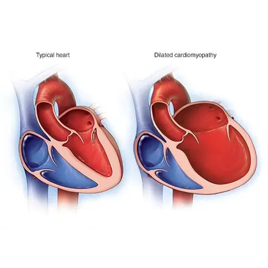 Hypertrophic Cardiomyopathy : Symptoms, Causes and Treatment | Ganesh ...