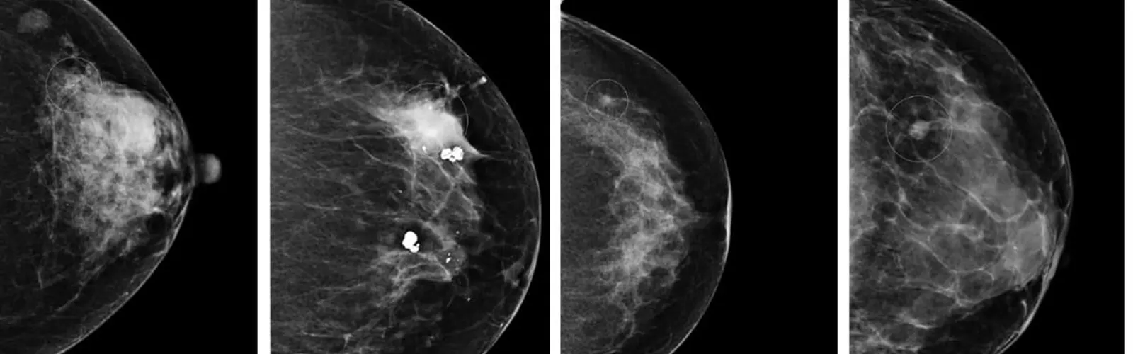 What Is The Role Of Mammography In Cancer? | Ganesh Diagnostic