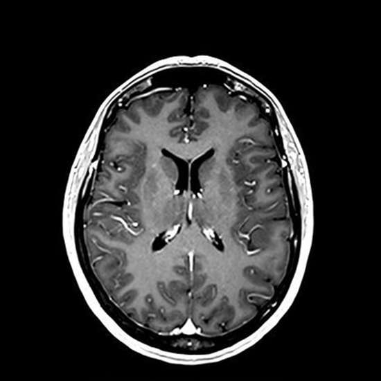 normal brain mri with contrast