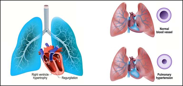 Pulmonary Hypertension : A Comprehensive Guide to Understanding and ...