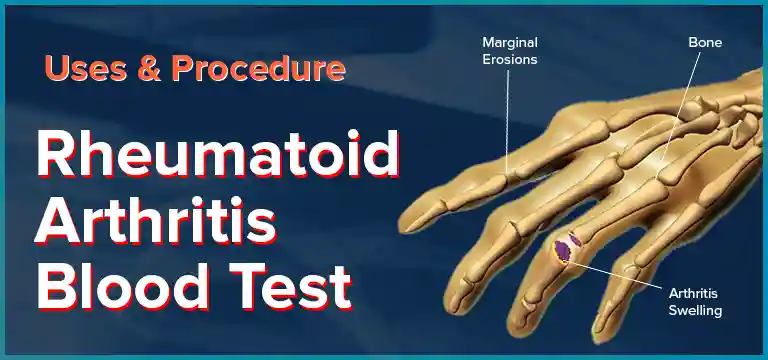 What is Rheumatoid Arthritis Blood Test - Uses, Procedure and Cost