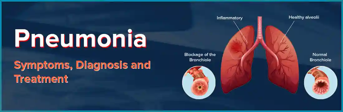 Pneumonia: Cause, Symptoms, Diagnosis and Treatment