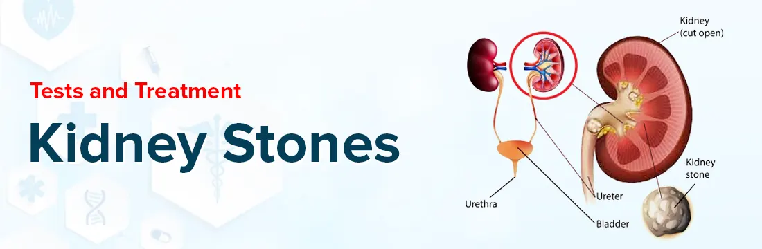 Kidney Stones - Tests and Treatment | Ganesh Diagnostic