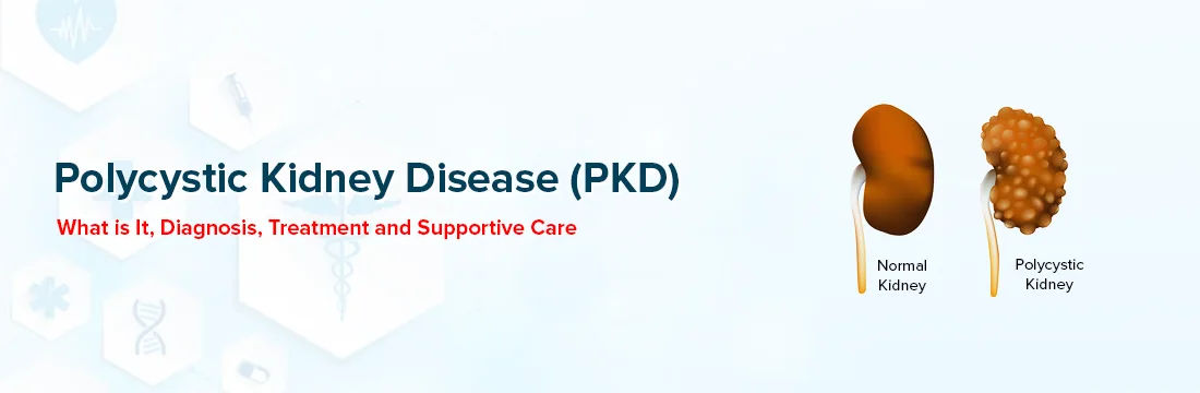 Polycystic Kidney Disease (PKD): What Is It, Diagnosis, Treatment and ...