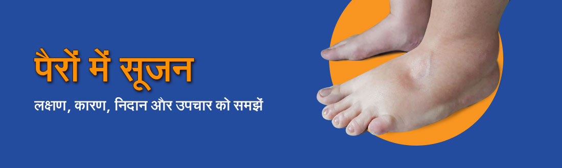 पैरों में सूजन (Swelling in Feet) : लक्षण, कारण, निदान और उपचार को समझें