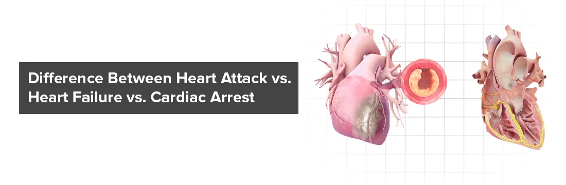 Difference Between Heart Attack vs Heart Failure vs Cardiac Arrest