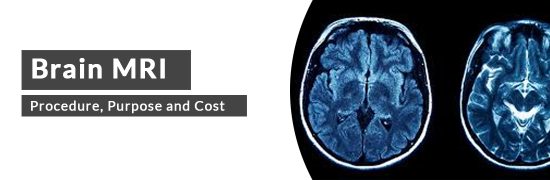 Brain MRI: Procedure, Purpose, Cost and Best MRI Centre in Delhi