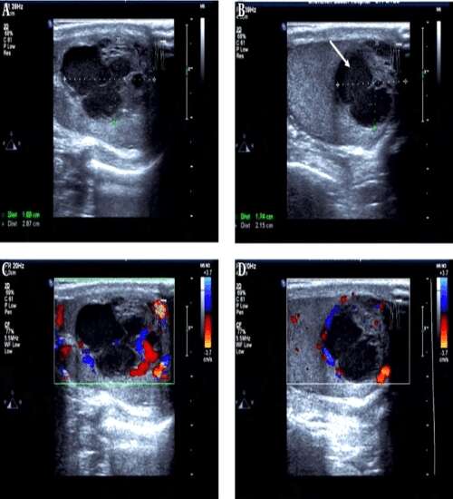 Book Scrotal Colour Doppler | Test Price In Delhi | Ganesh Diagnostic