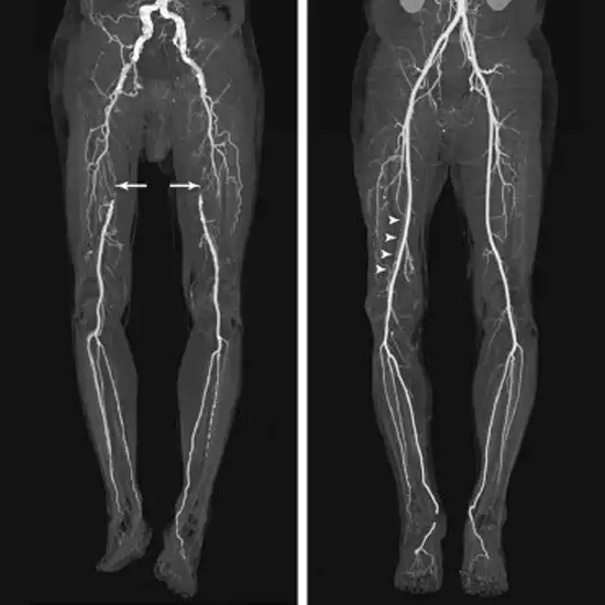 CT Angiography Venous Lower Limb | Test Price In Delhi | Ganesh Diagnostic