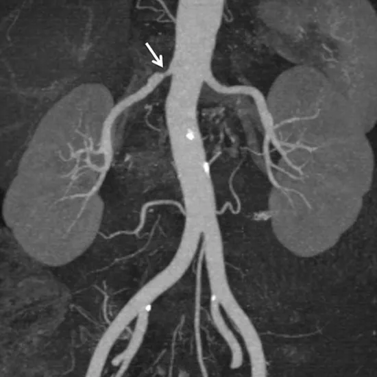 MR Angiography Renal Vessels Scan Test Near You in Delhi | Book Test at ...