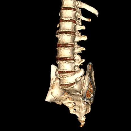 3D CT LS Spine | Test Price in Delhi | Ganesh Diagnostic