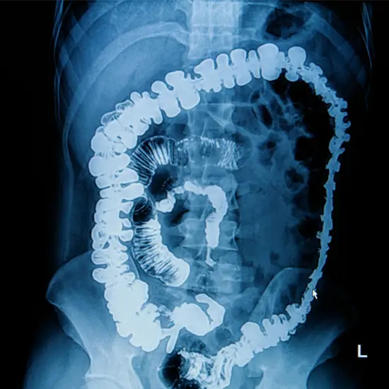 X-Ray Total Barium Meal | Test Price In Delhi | Ganesh Diagnostic