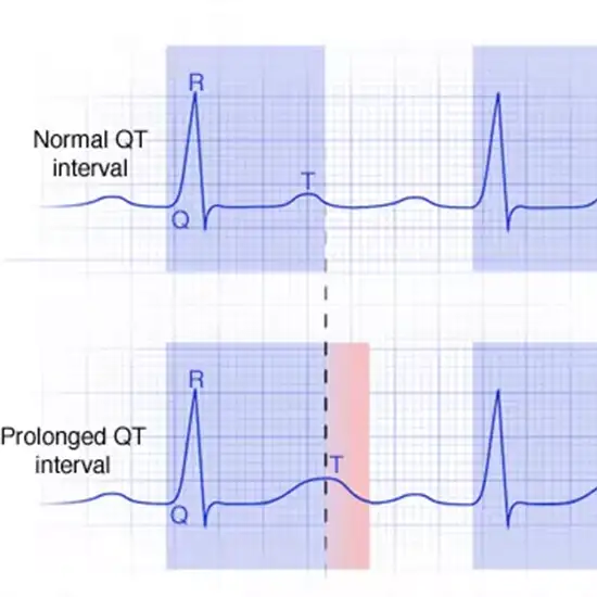 Book Genetic Testing For Long QT Syndrome | Test Price In Delhi, India ...