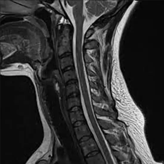 MRI Cervical Spine With Contrast Test Near You in Delhi