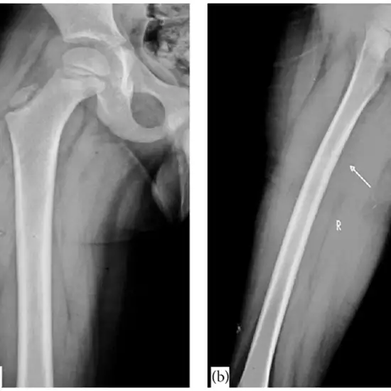 X-ray Both Femur-Thigh AP/LAT