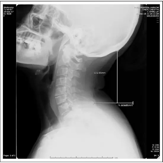 X-ray Cervical Spine Lateral, Test Price in Delhi