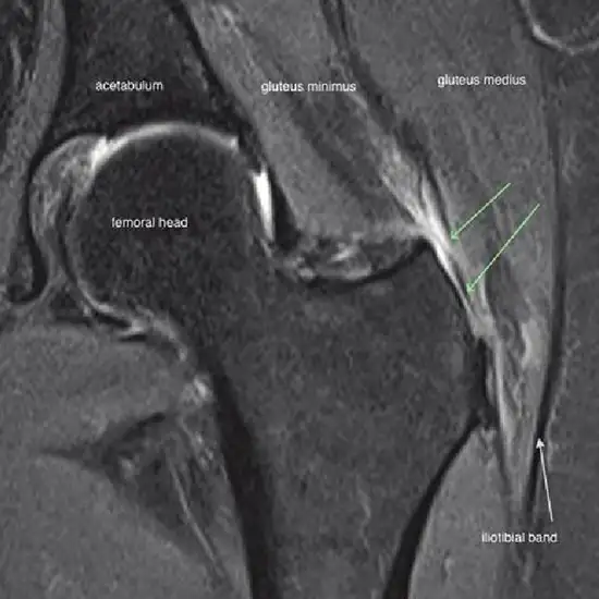 Gluteal muscles, Radiology Reference Article