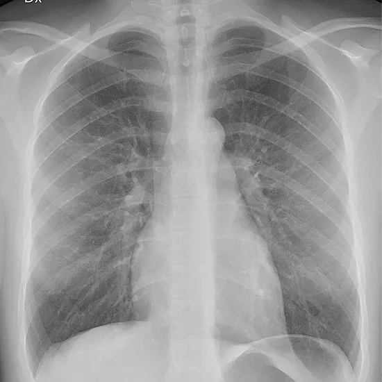 Chest X-Ray Lordotic view (chest axial view) Procedure