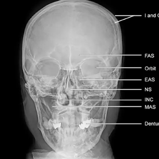 X-RAY ORBITS PA VIEW PROCEDURE