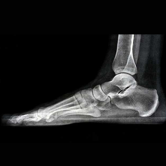 X-ray right foot AP and lateral view done at the time of original