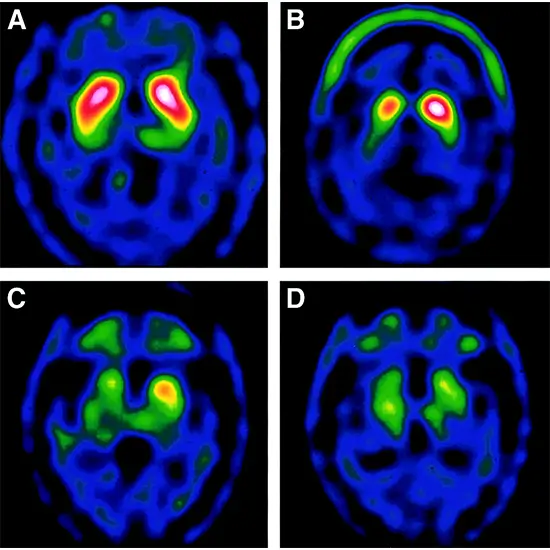 Trodat Brain Scan - Book Test at Flat 20% OFF | Nuclear Medicine