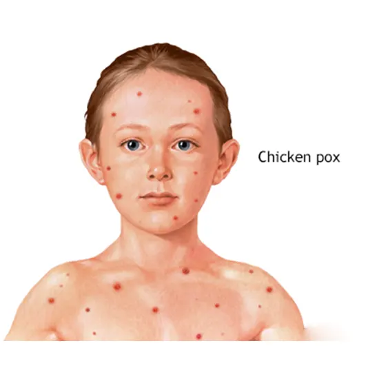 Varicella Zoster IgA (Chicken Pox) Test in Delhi NCR, India | GDIC