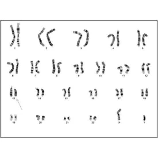 Retinoblastoma - Deletion/Duplication Test in Delhi NCR, India | GDIC