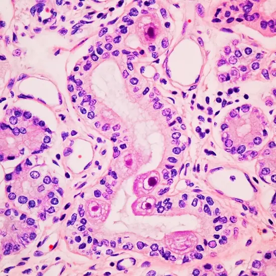 CA 27.29 & CA 15.3; Breast Cancer Marker Panel