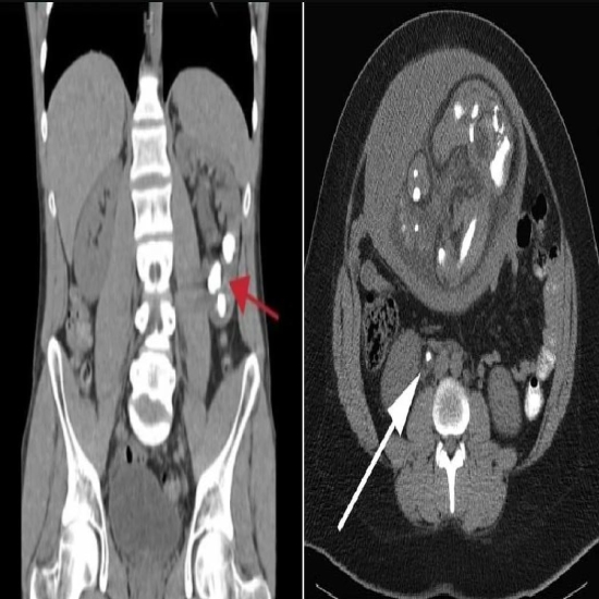 CT KUB Scans